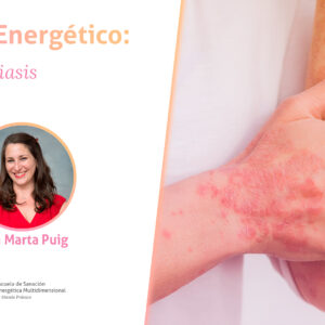 Cap 50 Psoriasis